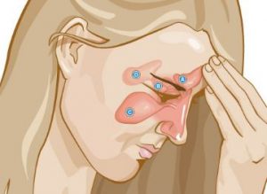 Aliviar los sintomas de la sinusitis